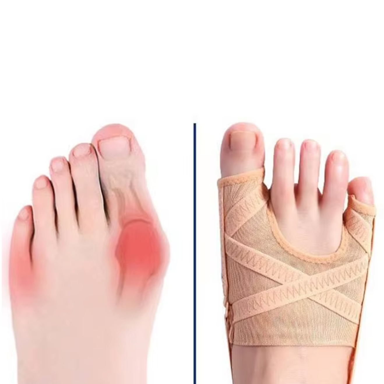 Orthèse hallux valgus souple