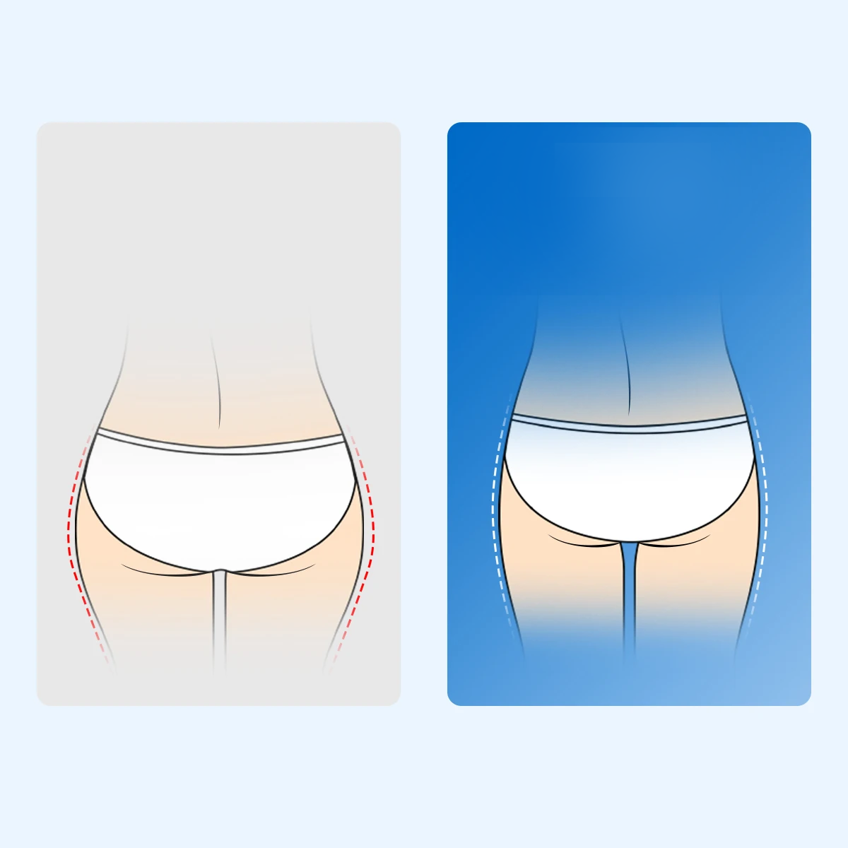 Ceinture sacro iliaque Velpeau