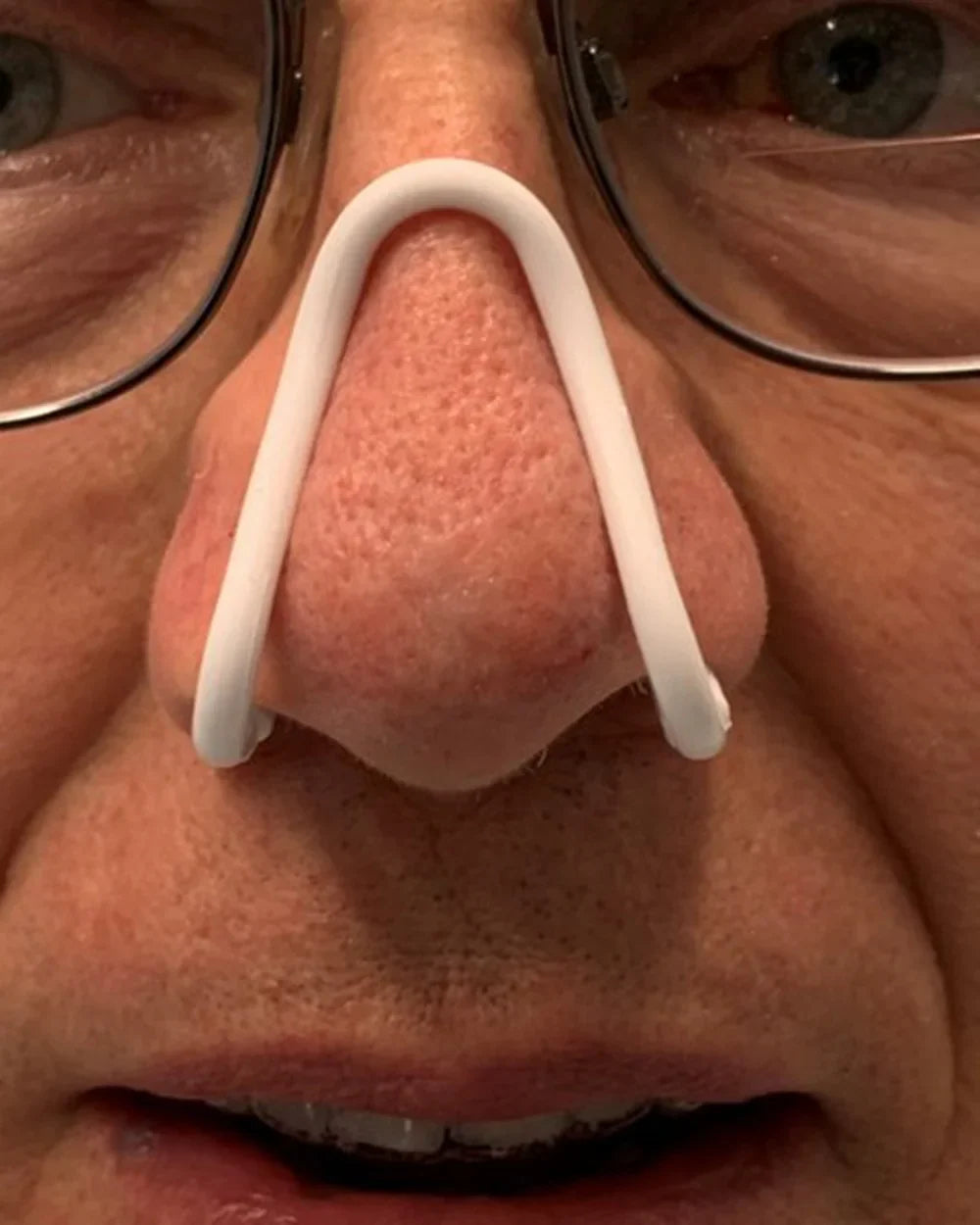 Écarteur nasal anti-ronflements